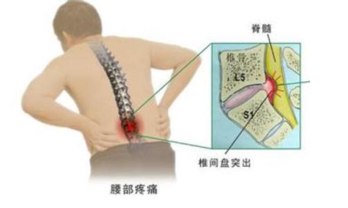 椎間盤突出