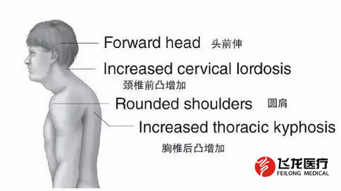 脊柱健康，不向生活“低頭”